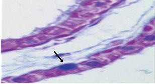Fotomicrografía de piel que muestra cuerpos de Lafora (caso 1)