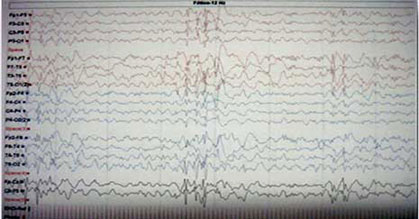Electroencefalograma en sueño fisiológico que muestra polipuntas generalizadas dentro ritmo de fondo lento (caso 1)