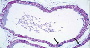 Fotomicrografía con aumento 40x que muestra los cuerpos de Lafora (caso 2)