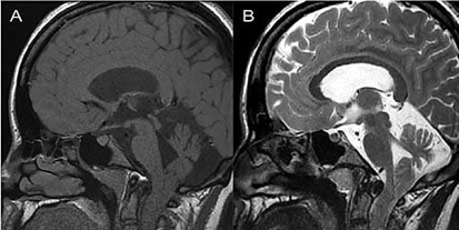 RM T1 y T2 de uni&oacute;n craneocervical, cortes sagitales, que evidencia desplazamiento caudal de am&iacute;gdalas cerebelosas y atrofia cerebelosa}