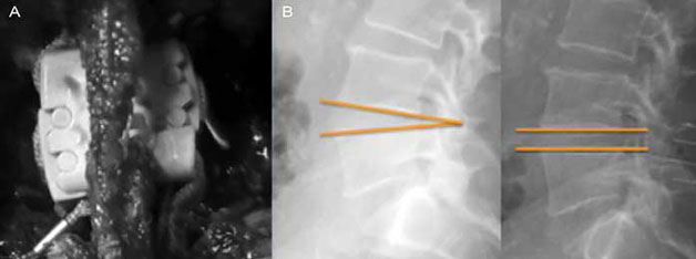 A) Imagen transoperatoria en la cual se observa la adecuada colocación de espaciador interespinoso conservando ligamento interespinoso. B) Imagen radiológica de control en la cual se aprecia aumento de diámetro del canal, aumento de diámetro de foramen y aumento del espacio intervertebral posterior