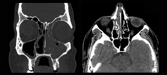 Sinusitis maxilar bilateral de predominio izquierdo