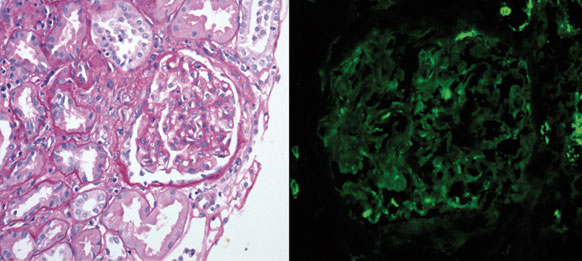  Biopsia renal que muestra glomerulonefritis necrosante, fibrinoide y segmentaria focal con escasos dep&oacute;sitos de complejos inmunes y compatible con glomerulonefritis pauciinmune IgA negativa
