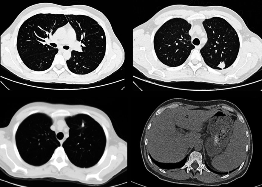 Tomograf&iacute;a toraco-abdominal en la que se ve la presencia de n&oacute;dulos subpleurales y en par&eacute;nquima, as&iacute; como hepatoesplenomegalia
