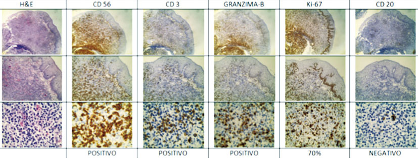 Biopsia de &uacute;lcera far&iacute;ngea: pared posterior de orofaringe con epitelio plano estratificado. El estroma presenta borramiento de la arquitectura por abundante infiltrado inflamatorio polimorfo por linfocitos, histiocitos, c&eacute;lulas plasm&aacute;ticas y escasos eosin&oacute;filos. Los linfocitos neopl&aacute;sicos son de medianos a grandes, con citoplasma amplio, de n&uacute;cleos redondos y cromatina granular. Hay proliferaci&oacute;n de peque&ntilde;os vasos con hiperplasia endotelial