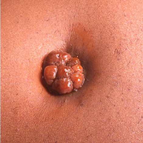 Apariencia prequirúrgica de tumoración umbilical multilobulada