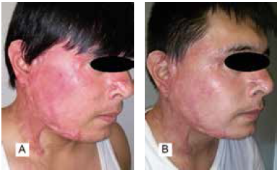 A) Cicatriz patol&oacute;gica antes del tratamiento. B) Cicatriz patol&oacute;gica despu&eacute;s del tratamiento