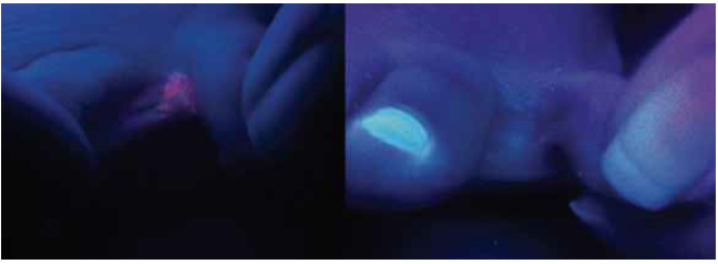 Exploraci&oacute;n con luz de Wood con coloraci&oacute;n rojo coral. Antes y despu&eacute;s del tratamiento con aceite de oliva ozonificado