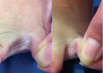 Datos cl&iacute;nicos antes y despu&eacute;s del tratamiento con aceite de oliva ozonificado