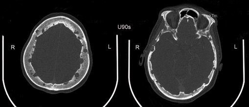 Cortes axiales de tomograf&iacute;a de cr&aacute;neo en la que se observan lesiones l&iacute;ticas de entre 1 y 11 mm en toda la extensi&oacute;n del cr&aacute;neo, y que producen soluciones de continuidad tanto en cortical interna como externa del diploide