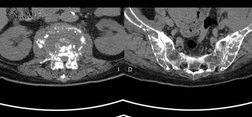 Cortes axiales de tomograf&iacute;a en la que se observa destrucci&oacute;n y p&eacute;rdida de la anatom&iacute;a del cuerpo de L3 correspondiente a fractura por compresi&oacute;n del mismo (izquierda) y lesioness l&iacute;ticas y osteopenia a nivel del sacro y ambas crestas iliacas (derecha)