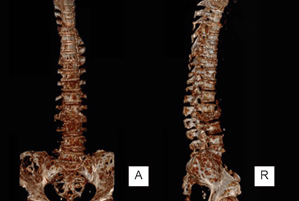Reconstrucci&oacute;n tridimensional de tomograf&iacute;a de columna vertebral y sacro en el que se identifica fractura por compresi&oacute;n del cuerpo vertebral de L3, peque&ntilde;a fractura por compresi&oacute;n del cuerpo de T12, lesiones l&iacute;ticas en cuerpo y alas del sacro, crestas iliacas y m&uacute;ltiples cuerpos vertebrales dorsales y lumbares