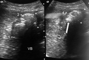 Se observa hacia topograf&iacute;a vesicular un eco intenso, el cual condiciona sombra posterior; se mide esta formaci&oacute;n piriforme, siendo de 61.4 mm x 36 mm. Adem&aacute;s, observamos ecos suaves que no producen sombra en relaci&oacute;n a lodo biliar