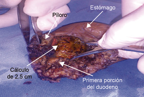 Se llev&oacute; a cabo una incisi&oacute;n de 6 cm que abarc&oacute; la primera porci&oacute;n del duodeno y p&iacute;loro, as&iacute; como 2 cm de est&oacute;mago, observando un c&aacute;lculo de 2.5 cm, el cual fue extra&iacute;do