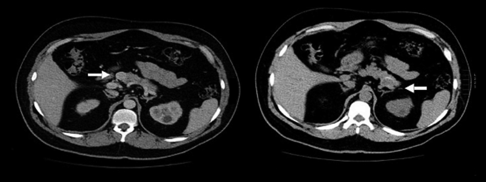  Tomografía axial computarizada toracoabdominal que
evidencia una lesión en la cabeza del páncreas de 10 mm, hipodensa y homogénea
con el medio de contraste (imagen superior) y otra lesión en la cola del
páncreas de 18 mm sin reforzamiento (imagen inferior)