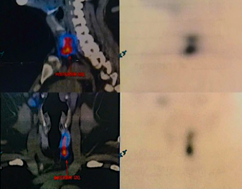 Gammagrama con tejido paratiroideo hipercaptante en
porción inferior y posterior del lóbulo tiroideo izquierdo