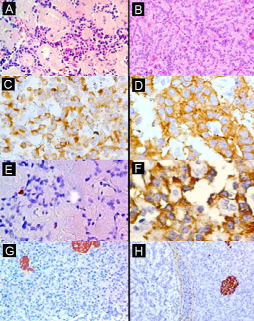 A) Hematoxilina-eosina (HE) 10 x: tumor con nidos y
cordones de células neuroendócrinas, rodeados por amiloide; B) HE 10 x: áreas
con patrón trabecular; C) inmunohistoquímica (IHQ) 4 x: cromogranina positiva;
D) IHQ 4 x: sinaptofisina positiva; E) IHQ 4 x Ki 67 positivo en 1% de las
células neoplásicas; F) IHQ 10 x: insulina positiva en células neoplásicas; G y
H) IHQ 10 x, tumores de menor tamaño no reactivos a insulina y control interno
positivo