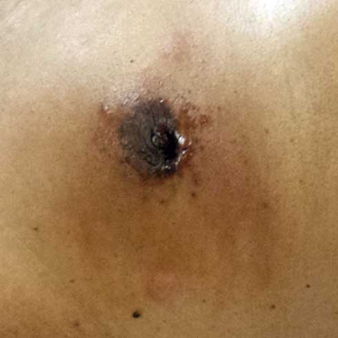 Retracci&oacute;n del pez&oacute;n con tumoraci&oacute;n palpable de 4 cent&iacute;metros,
retroareolar