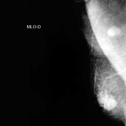 Mastograf&iacute;a en proyecci&oacute;n oblicua medio lateral. Se observa tumoraci&oacute;n
retroareolar de 4 cent&iacute;metros y ganglio axilar irregular, radiopaco, de aspecto
metast&aacute;sico