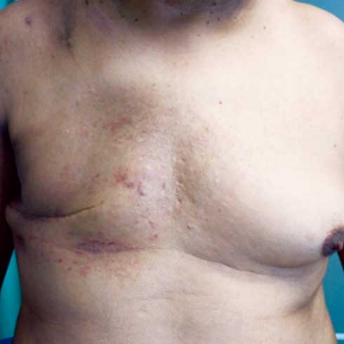 Cambios cut&aacute;neos posteriores a radioterapia y herida quir&uacute;rgica bien
cicatrizada