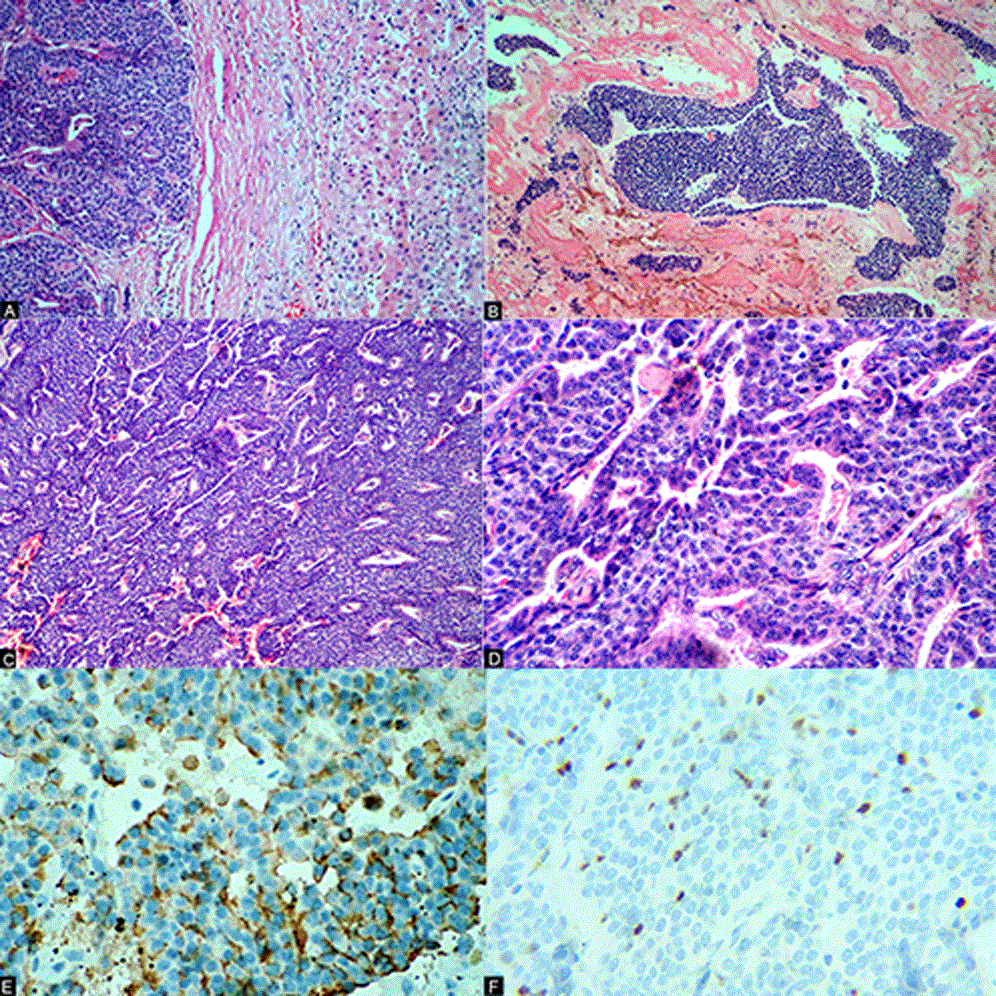A) Imagen en hematoxilina eosina a 5x, células neuroendócrinas dispuestas en nidos y parénquima hepático residual; B) imagen
en hematoxilina eosina a 10x, áreas sólidas de la neoplasia; C) imagen en hematoxilina eosina a 5x, patrón trabecular; D) imagen en
hematoxilina eosina a 40x, células pequeñas con citoplasma eosinófilo y núcleos granulares en “sal y pimienta”; E) tinción de
inmunohistoquímica para cromogranina inmunoreactiva a 40x; F) tinción de inmunohistoquímica de Ki-67 con índice de proliferación del
10% a 40x