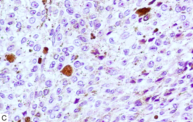C. Células neoplásicas pleomórficas, con núcleos grandes, nucléolos prominentes y pigmento de melanina (hematoxilina-eosina, 40x)