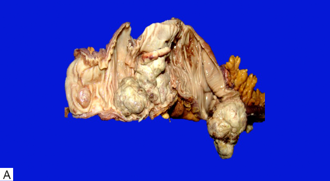 A. Imagen macroscópica de colon con múltiples tumores intraluminales polipopides y nodulares. 