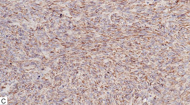 C. Inmunomarcación para CD117, positivo (3+) difuso (10x).