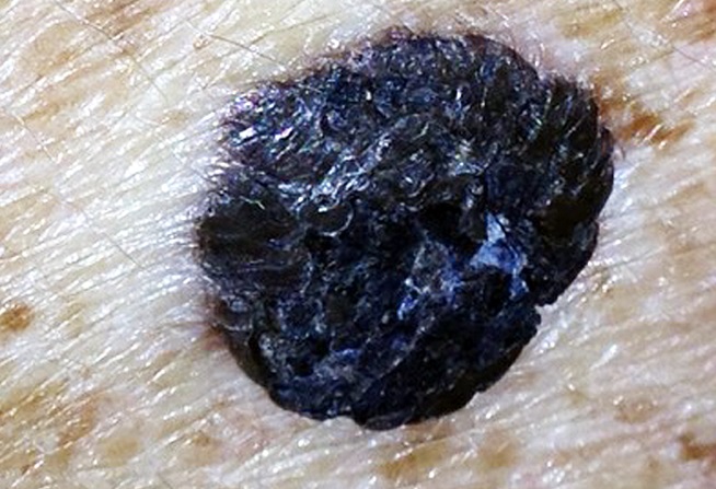 Melanoma cutáneo del paciente. Aspecto nodular, localizado en el tercio superior de la espalda.