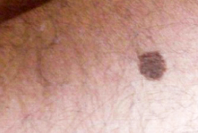  Melanoma cutáneo del paciente. Tipo diseminación superficial, en el antebrazo derecho