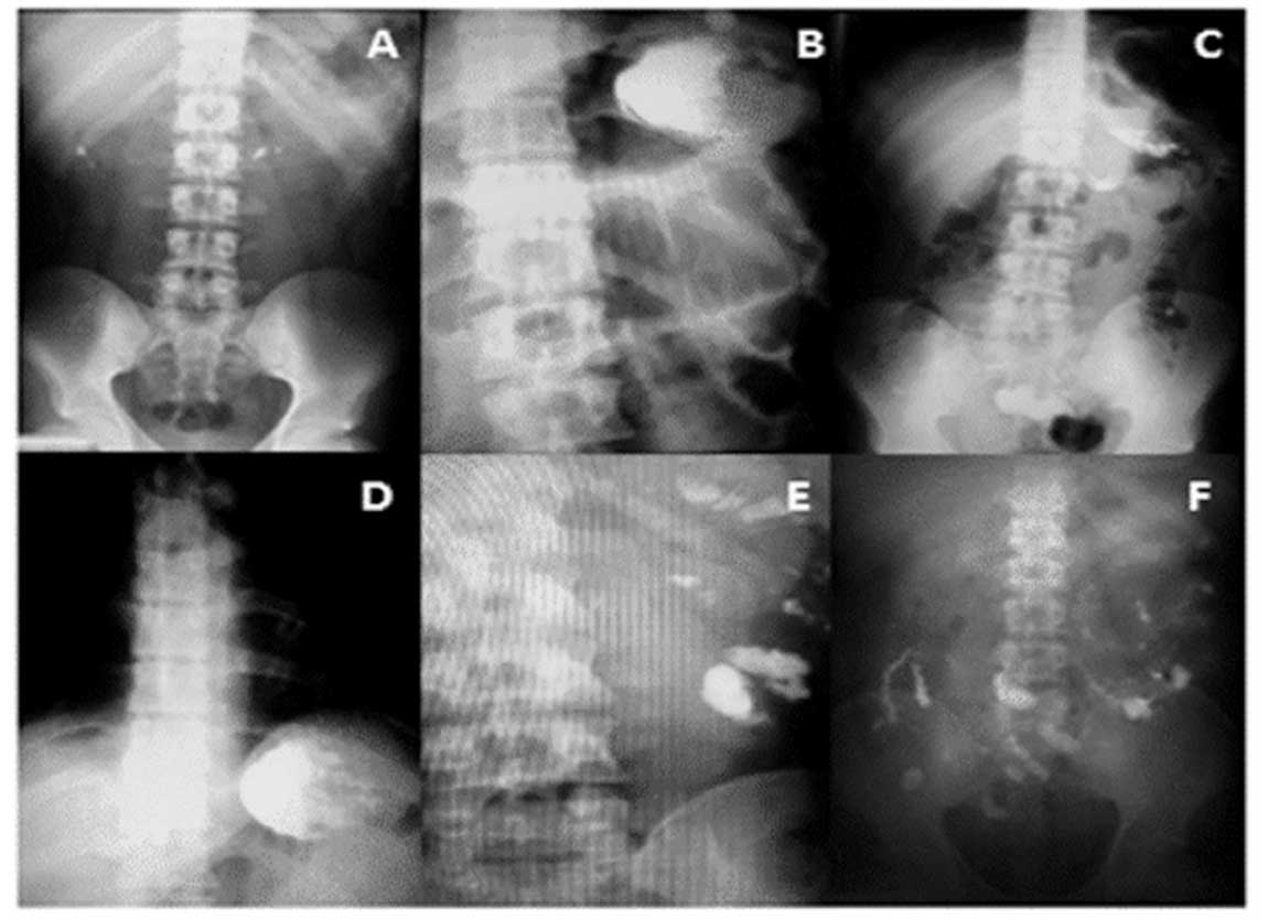 Imágenes radioópacas del fosfuro en abdomen