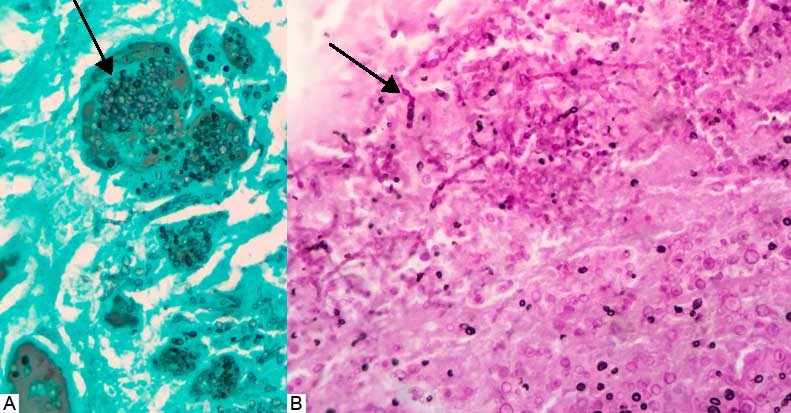 Cortes histológicos de la vegetación valvular (40X). A: Tinción de Grocott-plata-metenamina, se oberva material fibrino-necrótico adherido a la superficie valvular, con abundantes levaduras de 3 a 4 µM de diámetro. B: tinción de PAS (ácido periódico de Schiff), se observan estructuras filamentosas de aspecto tortuoso, vesiculoso.