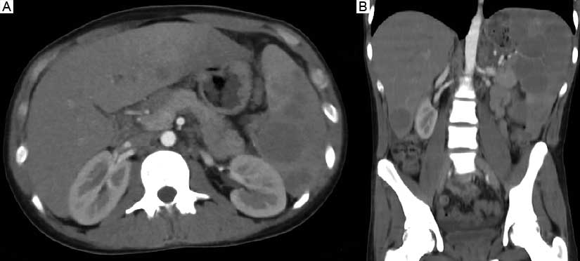 Tomografía abdominopélvica A Corte axial Imágenes heterogéneas circulares con leve reforzamiento con medio de contraste en bazo y lóbulo izquierdo del hígado B Corte coronal Franca hepatoesplenomegalia con lesiones circulares y leve reforzamiento con el contraste