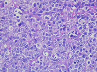 Preparación de bazo con hematoxilina y eosina (aumento 40X). Infiltración de linfoma de Burkitt. Proliferación difusa de células linfoides neoplásicas (grandes y atípicas) con patrón de “cielo estrellado” y mitosis atípicas.