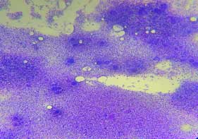 Aspirado de médula ósea con tinción de Wright 10X celularidad  megacariocitos 25  30 por campo