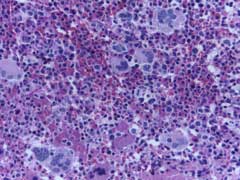 Biopsia de médula ósea con tinción hematoxilina eosina, mostrando celularidad 90% con hiperplasia de serie megacariocítica. Megacariocitos grandes hiperlobulados y en algunos lóbulos separados