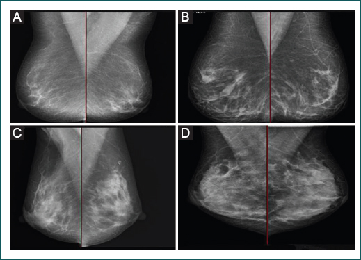 Composici�n de la mama seg�n la clasificaci�n BI-RADS 5.� edici�n. A: las mamas son casi completamente grasas. B: hay �reas de densidad fibroglandular dispersas. C: las mamas son heterog�neamente densas, lo que puede oscurecer peque�os n�dulos. D: las mamas son extremadamente densas, lo que disminuye la sensibilidad de la mamograf�a.