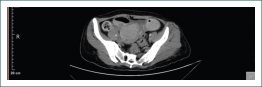 Corte transversal de tomografa de abdomen en fase simple y contrastada. Imagen compatible con un proceso compresivo que condiciona un desplazamiento (asterisco) de las estructuras plvicas (tero, vejiga y sigmoides).