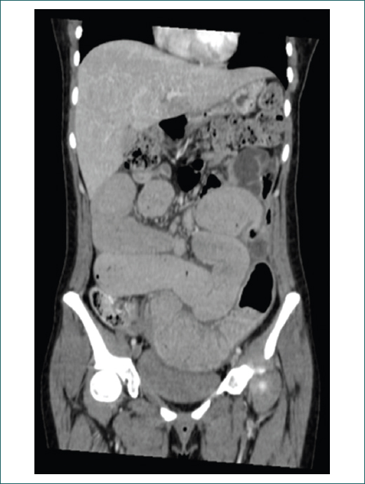 Corte coronal de tomografa de abdomen en fase simple y contrastada. Zona de estenosis a nivel del leon distal, aproximadamente a 7 cm de la vlvula ileocecal (asterisco).