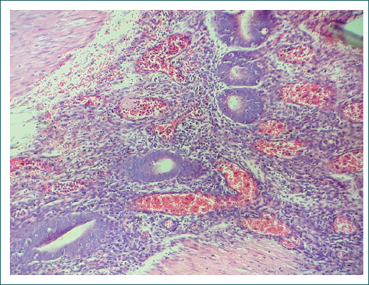 Microfotografa (40) de tincin de hematoxilina-eosina en la que se observa un corte histolgico de intestino delgado (leon), con presencia de glndulas (asteriscos) y estroma de tejido endometrial, con vasos sanguneos congestivos en su periferia e infiltrado linfoctico rodeado de fibras de msculo liso.