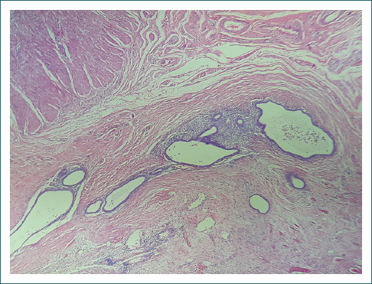 Fotomicrografa (10) de tincin con hematoxilina-eosina en la que se observan glndulas (asteriscos) y estroma de tejido endometrial entre ambas capas musculares del intestino.