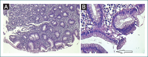 Biopsia g�strica. Presencia de gastritis cr�nica moderada con escasa cantidad de bacterias morfol�gicamente compatibles con Helicobacter pylori (flecha). Laminillas con hematoxilina y eosina. A: 4�. B: 40�.