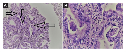 Presencia de Strongyloides stercolaris dentro de la mucosa g�strica (flechas). Laminillas con hematoxilina y eosina. A:10�. B: 40�.
