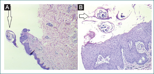 Biopsia de piel. Presencia de Strongyloides stercolaris dentro del estrato c�rneo. Laminillas con hematoxilina y eosina. A: 4�. B: 40�.