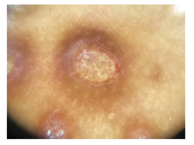 Imagen por dermatoscopa