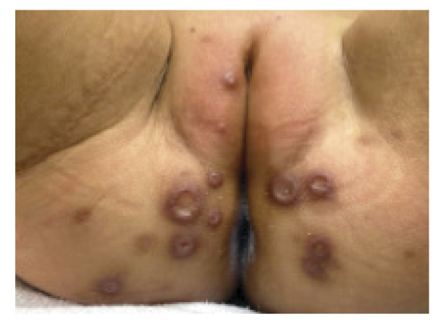 Imagen macroscpica de la lesin