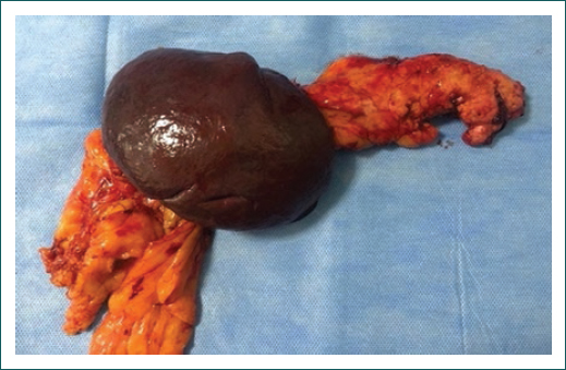 Producto de pancreatectoma corporocaudal ms esplenectoma.