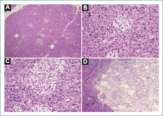 Estudio histolgico del pncreas. Tincin con hematoxilina-eosina. A: imagen panormica (10) que muestra los islotes de Langerhans incrementados en nmero y con variabilidad del tamao. B: imagen de acercamiento (40) que muestra un incremento de tamao en algunos ncleos. C:imagen de acercamiento (40) que muestra el complejo ductoacinar. D: imagen panormica que muestra una lesin microqustica benigna del pncreas.