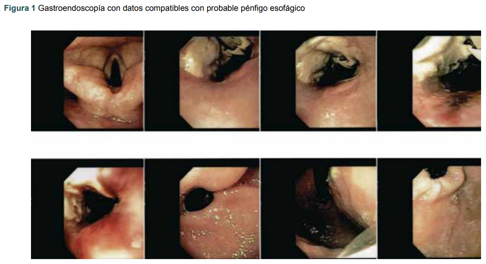 Gastroendoscop�a con datos compatibles con probable p�nfigo esof�gico