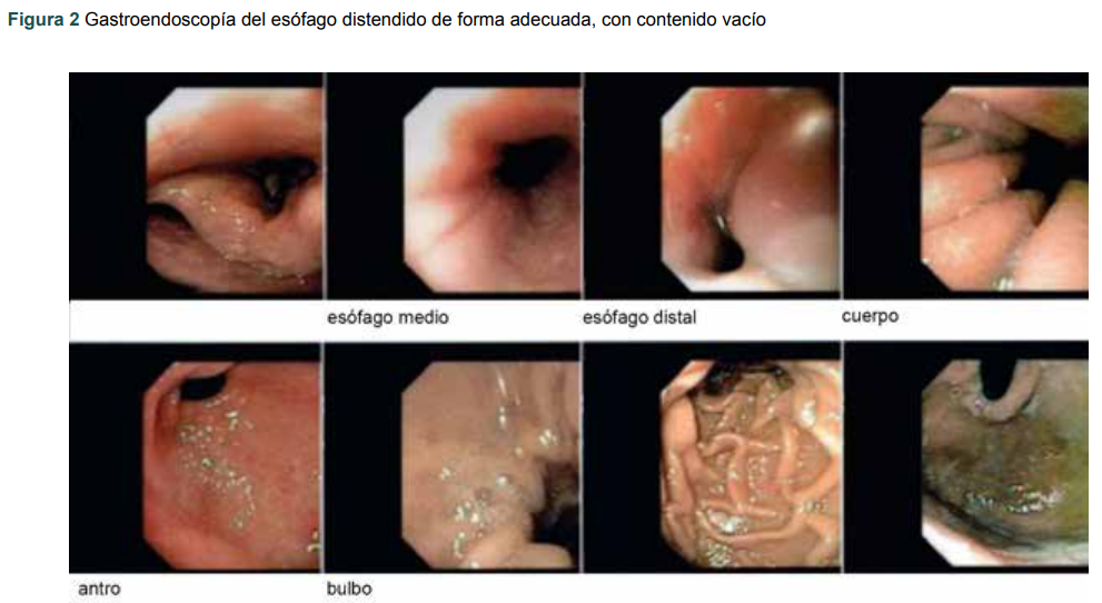 Gastroendoscop�a del es�fago distendido de forma adecuada, con contenido vac�o
